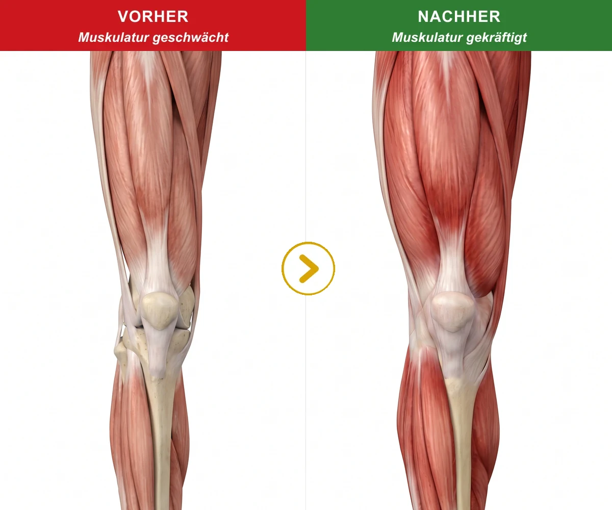 Kniegelenk im Vergleich: links die geschwächte, rechts die gekräftigte Muskulatur rund ums Knie